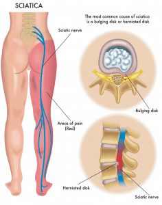 sciatica slipped disc