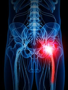 sciatica pain