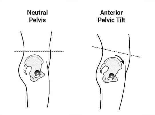 Anterior pelvic tilt 11