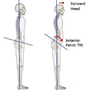 Anterior pelvic tilt 2